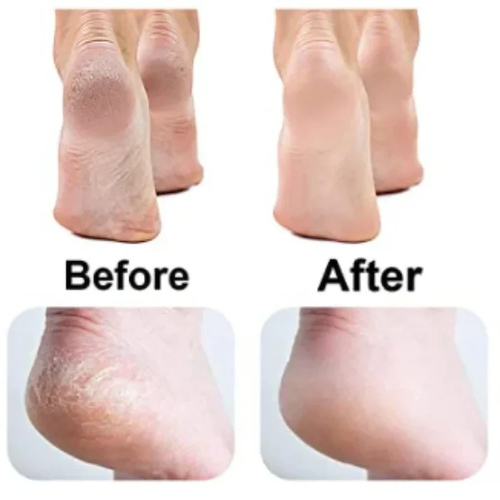 Electric Pedicure Foot Callus Grinder USB Charging Feet Care Dead Skin Remover Machine Foot File Callus Remover Cordless Foot File Easy Grip Adjustable - Image 3